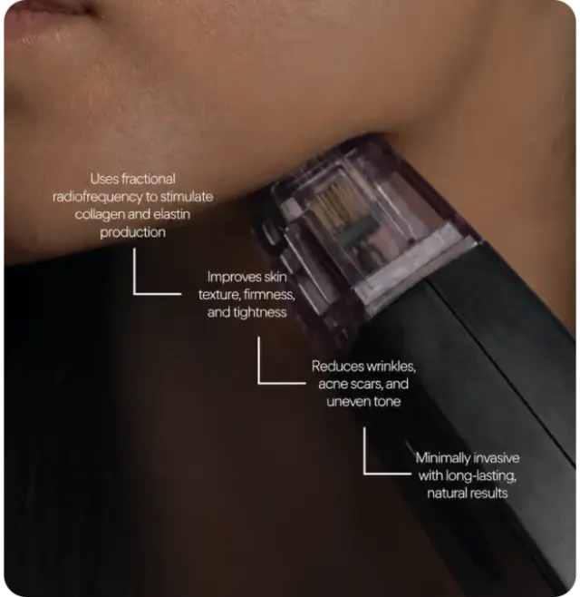 RF microneedling