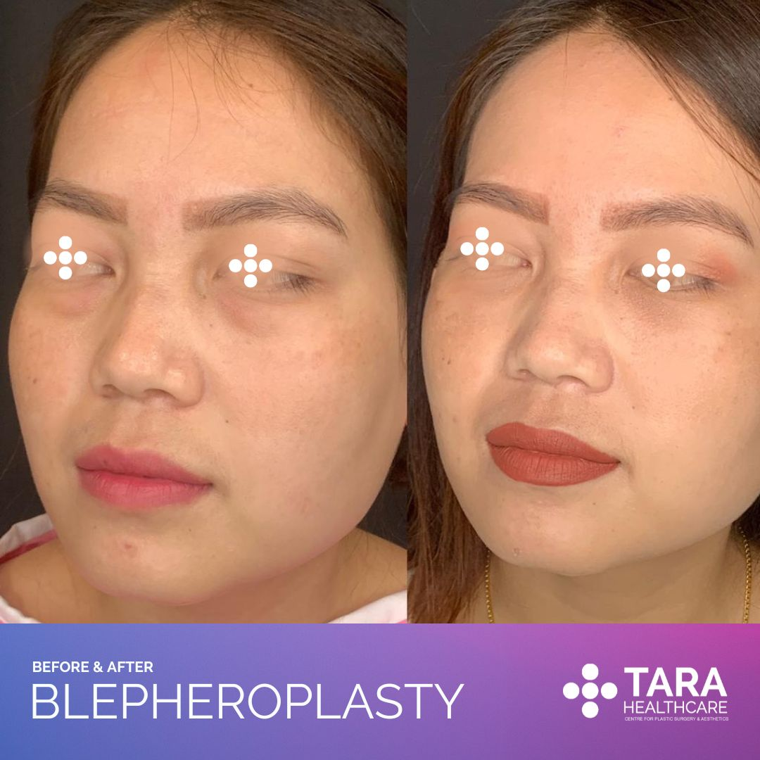 Blepheroplasty 1