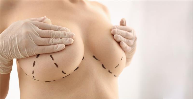 woman with marks chest breast augmentation 1 1