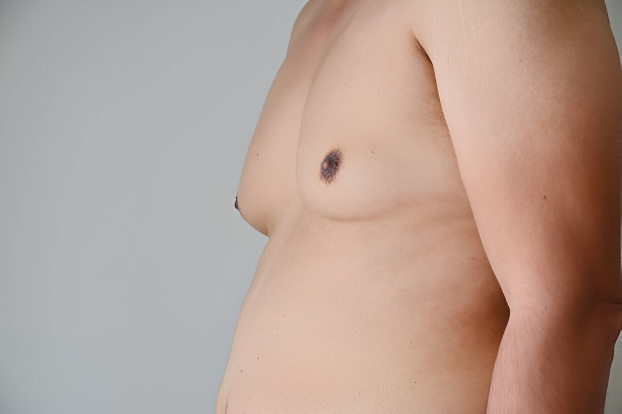 Gynecomastia